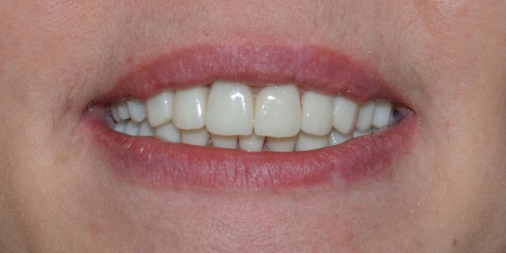 Восстановление формы и эстетики всех зубов коронками и винирами Е-max - фото №2