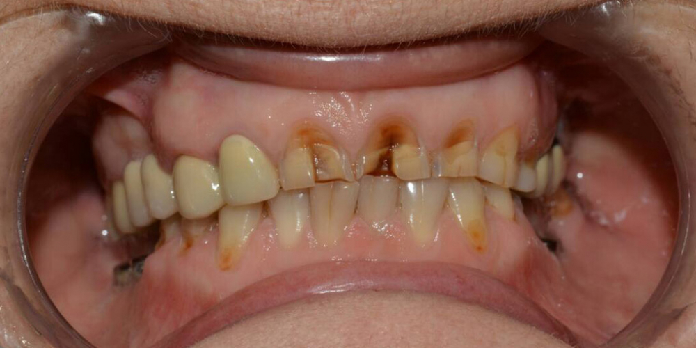 Восстановление зубов с использованием коронок на основе диоксида циркония и керамических виниров - фото №1