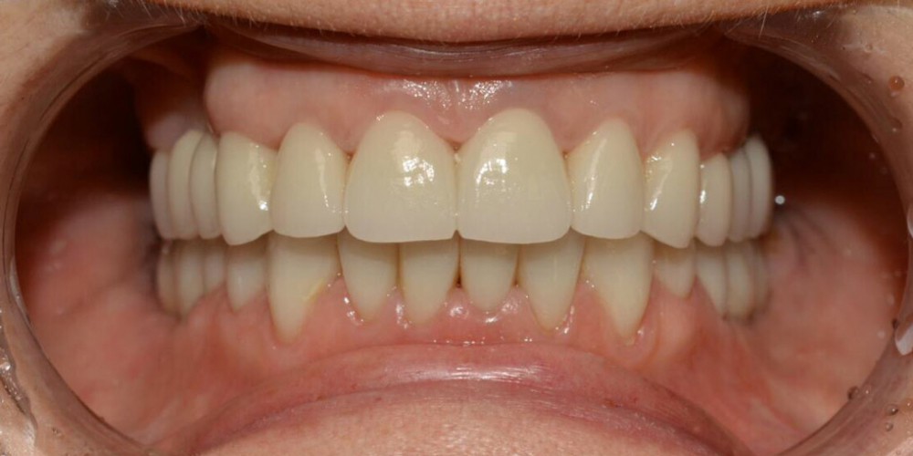 Восстановление зубов с использованием коронок на основе диоксида циркония и керамических виниров - фото №3
