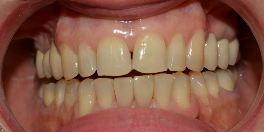 Неудовлетворительная эстетика двух передних нижних центральных зубов - фото №2