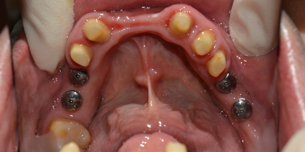 Восстановление отсутствующих зубов, эстетики и функции жевания МК коронками - фото №1