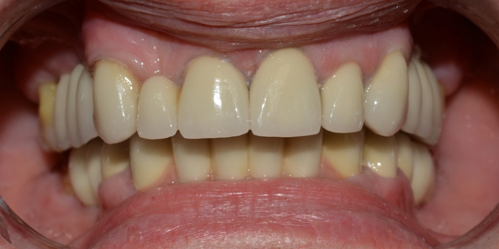 Восстановление отсутствующих зубов, эстетики и функции жевания МК коронками - фото №2