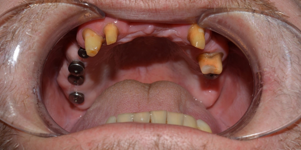 Восстановление зубов ВЧ с использованием имплантатов и мостовидных протезов на своих зубах - фото №1