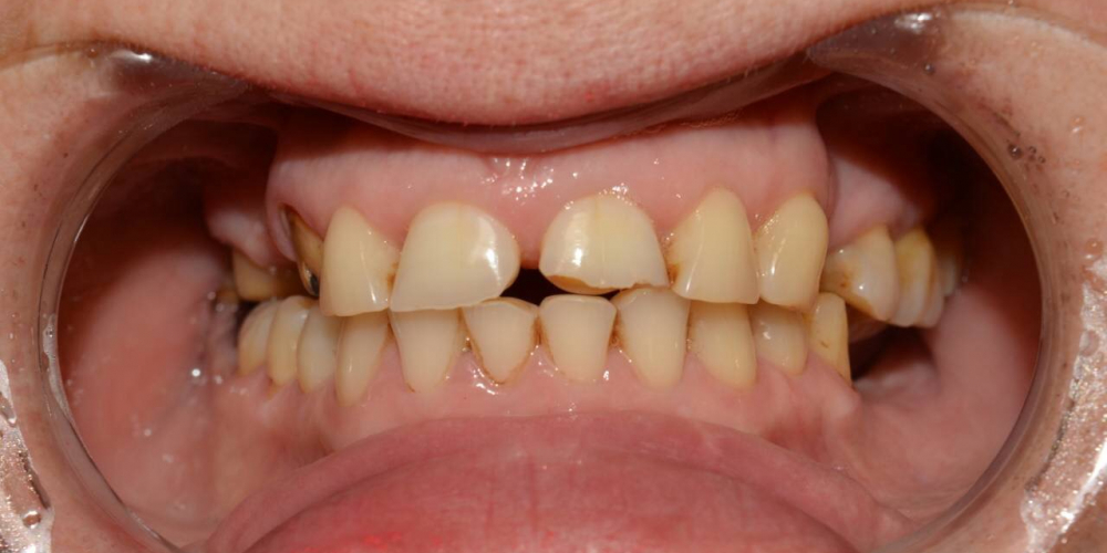 Установка 4 имплантатов для восстановления отсутствующих зубов - фото №1