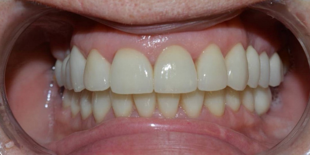 Установка 4 имплантатов для восстановления отсутствующих зубов - фото №2