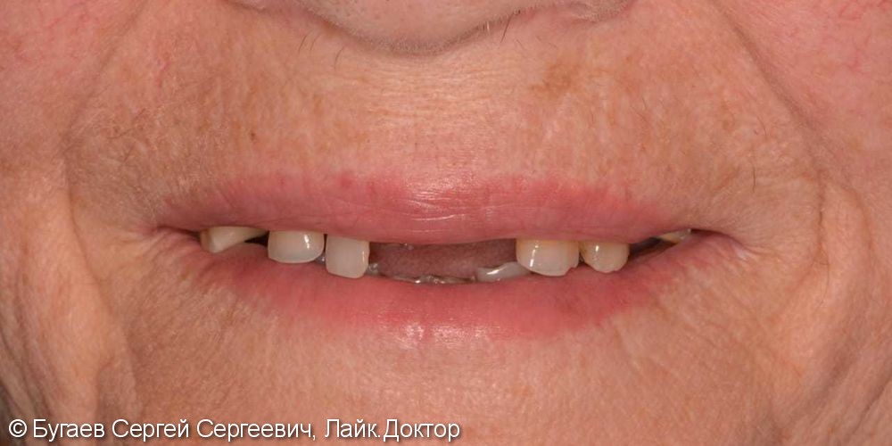 Восстановление эстетики и жевательной функции зубов на верхней и нижней челюстях - фото №1