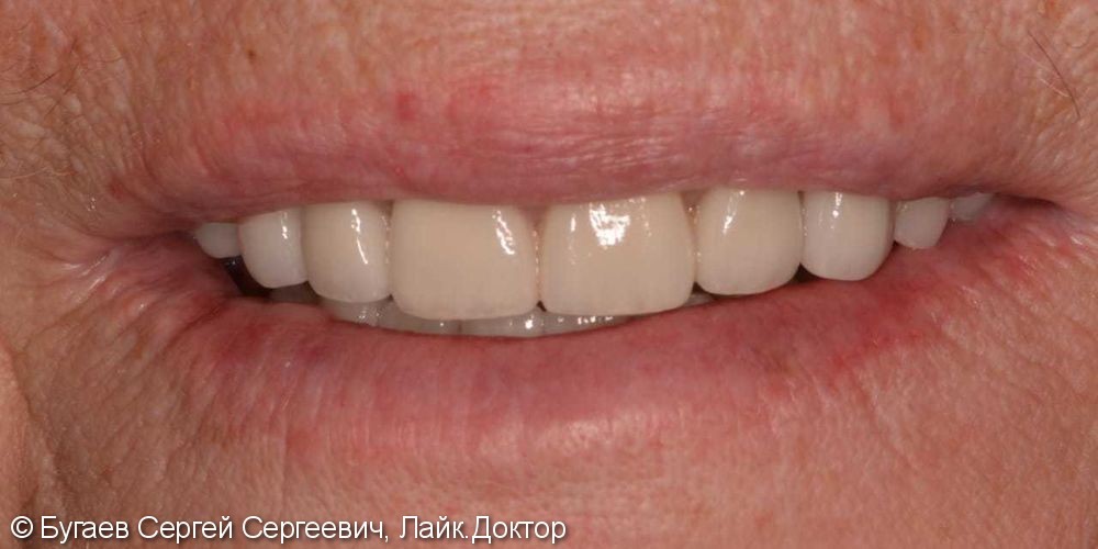 Восстановление эстетики и жевательной функции зубов на верхней и нижней челюстях - фото №2
