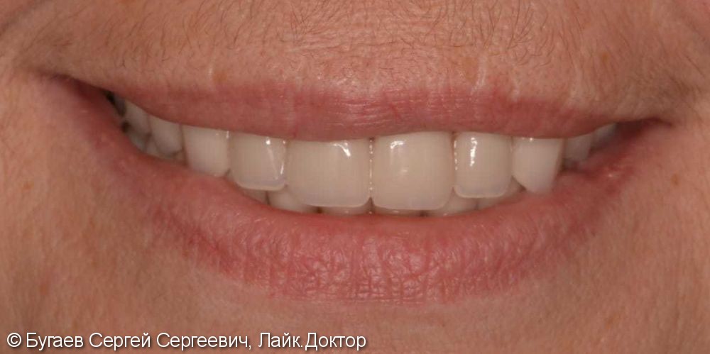 Восстановление функциональной и эстетической функции зубов - фото №4