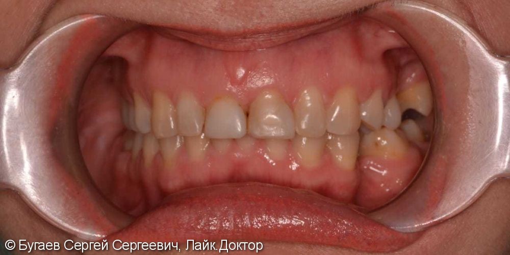 Полная эстетическая реставрция зубов верхней и нижней челюсти - фото №1
