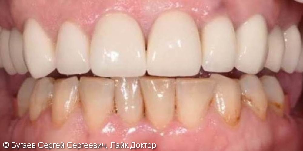 Эстетическое восстановление зубов на нижней челюсти - фото №1