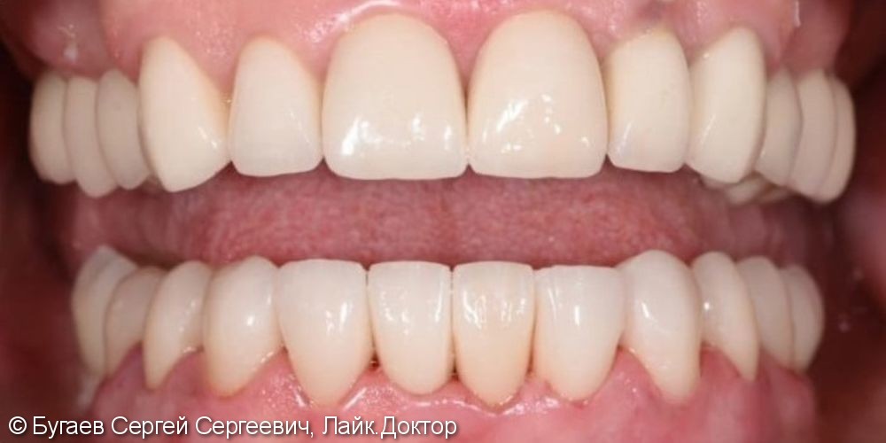 Эстетическое восстановление зубов на нижней челюсти - фото №2