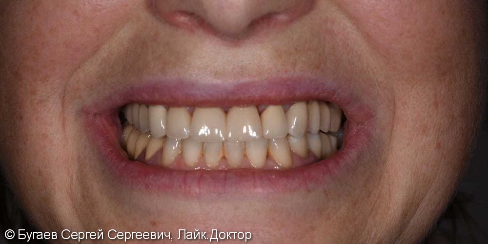 Протезирование зубов на верхней челюсти - фото №1