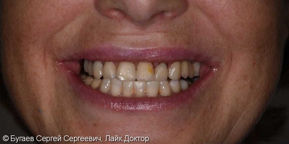 Протезирование зубов на верхней челюсти - фото №2