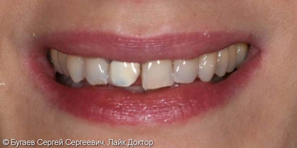 Восстановление 11 зуба безметалловой коронкой Emax - фото №1