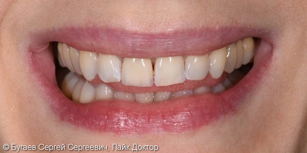 Восстановление 11 зуба безметалловой коронкой Emax - фото №2