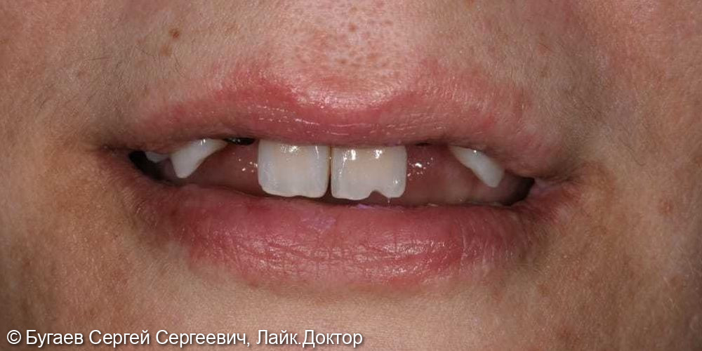 Восстановление зубов на верхней челюсти - фото №1