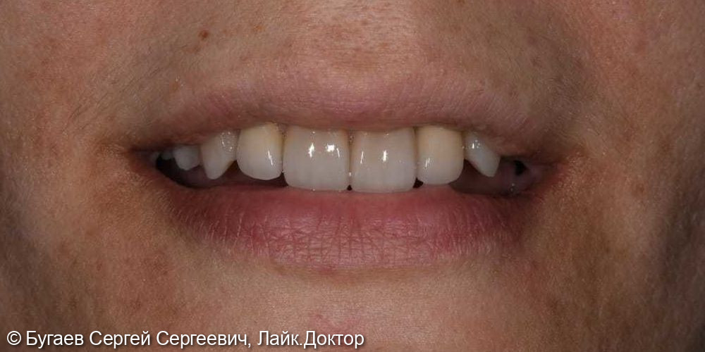 Восстановление зубов на верхней челюсти - фото №4