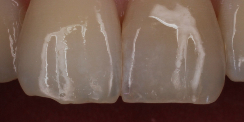 Оперативное устранения скола центрального зуба - фото №2