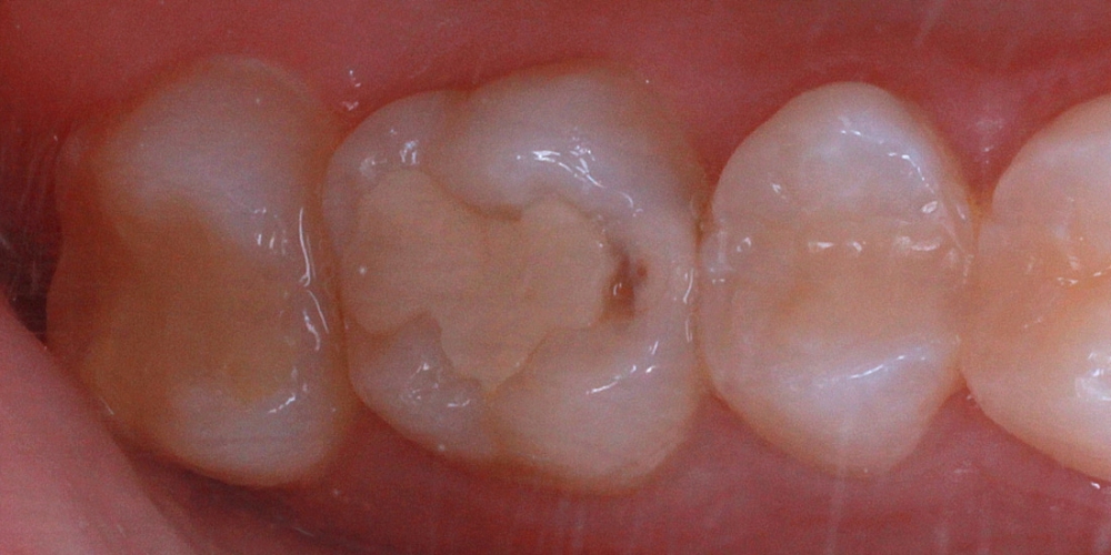 Замена пломбы и эстетическая реставрация жевательного зуба - фото №1