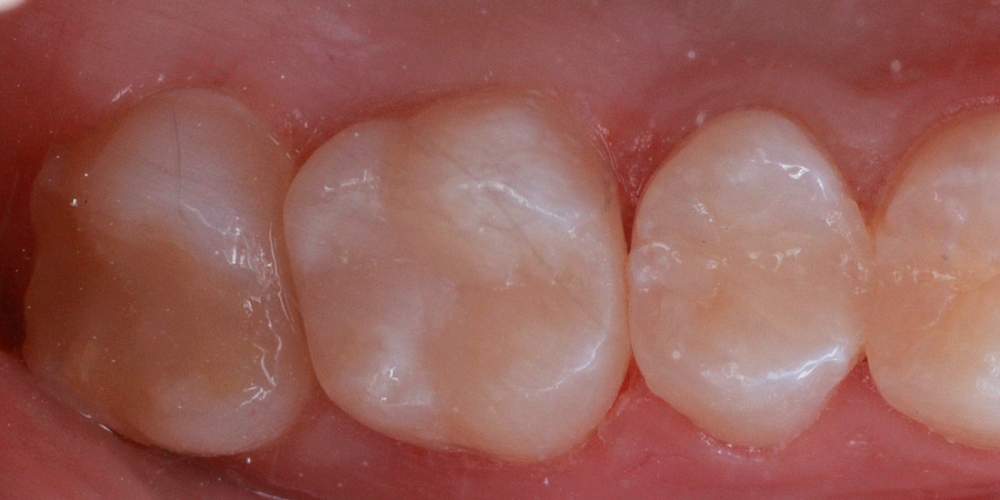 Замена пломбы и эстетическая реставрация жевательного зуба - фото №2