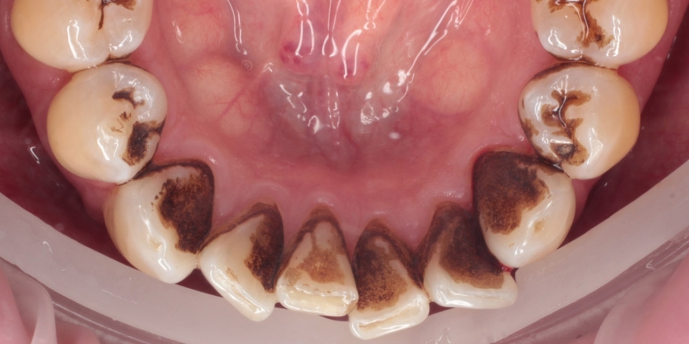 Снятие твердых зубных отложений (зубного камня) ультразвуком - фото №1