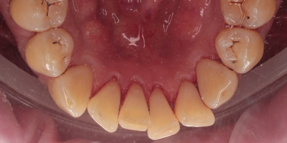 Снятие твердых зубных отложений (зубного камня) ультразвуком - фото №2