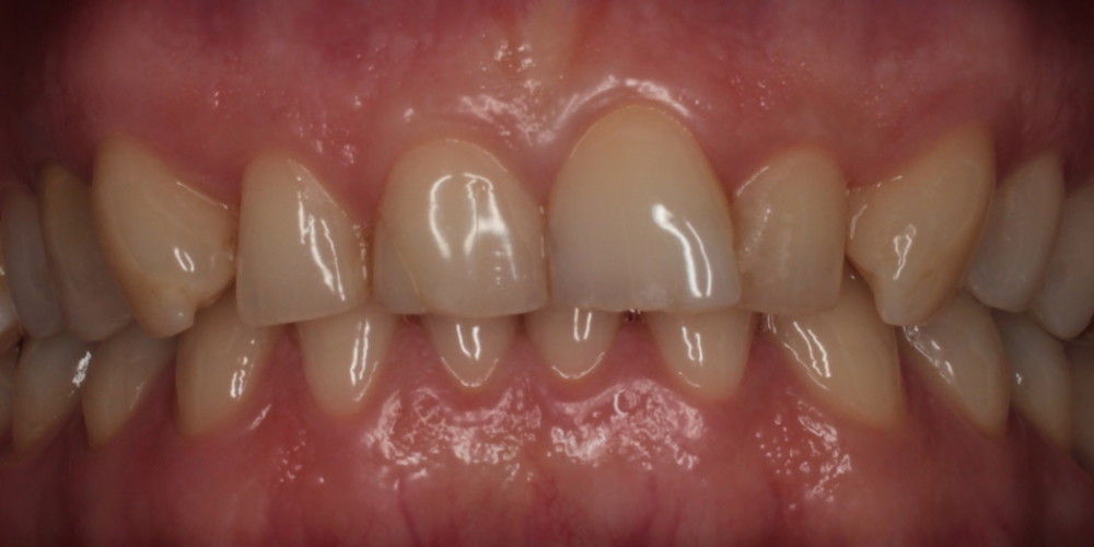 Удлинение коронковой части передних зубов - фото №1