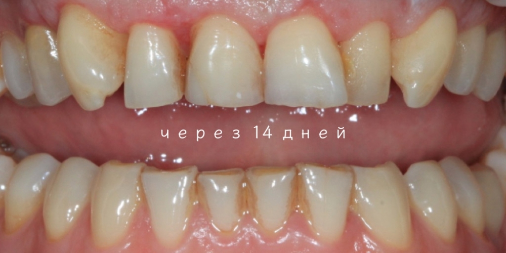 Удлинение коронковой части передних зубов - фото №2