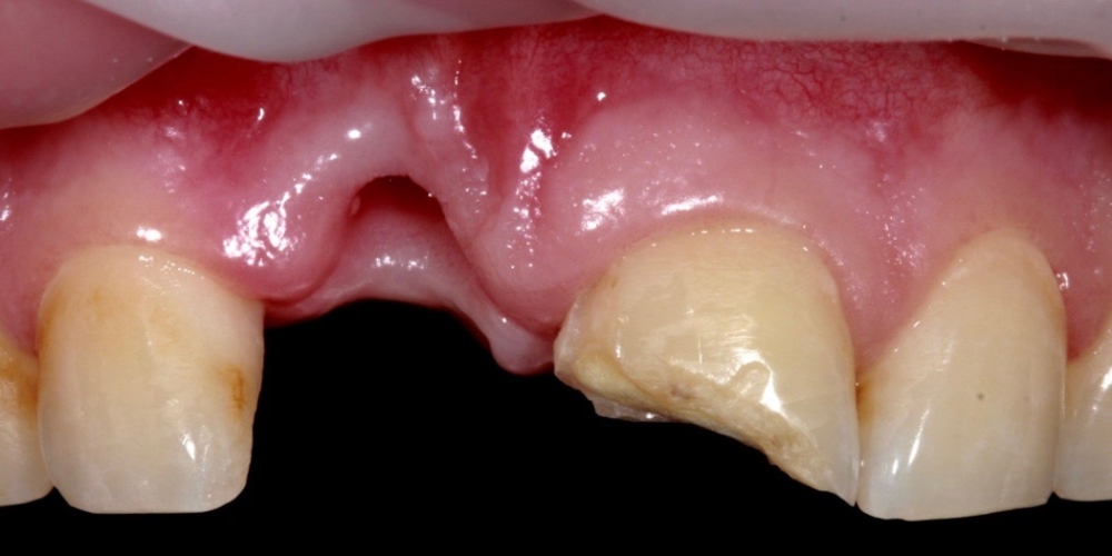Имплантация Дентиум и установка временных коронок на передние зубы - фото №1