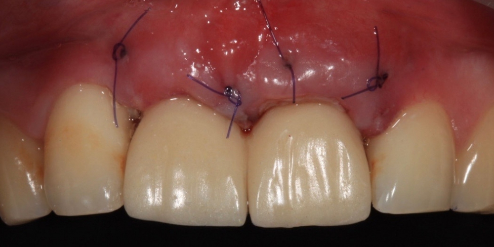 Имплантация Дентиум и установка временных коронок на передние зубы - фото №2