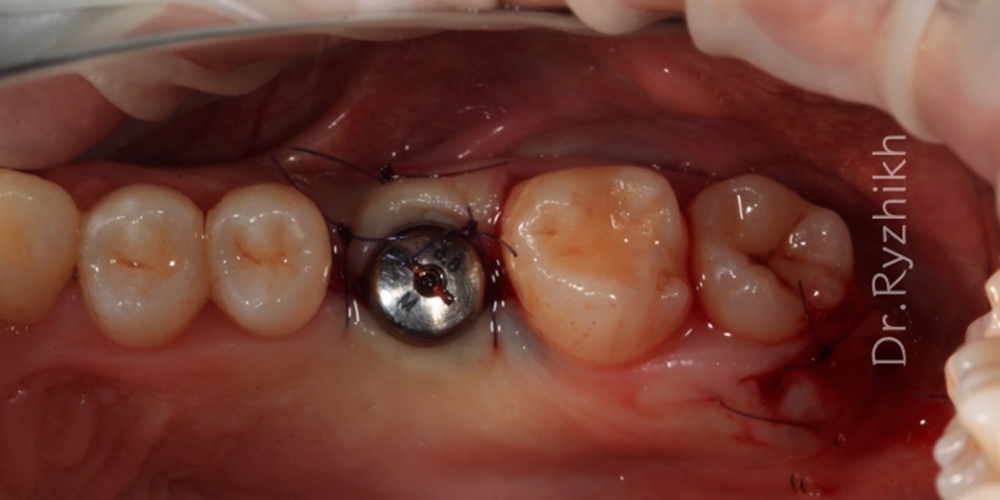 Установка имплантата Dentium + синус-лифтинг - фото №2