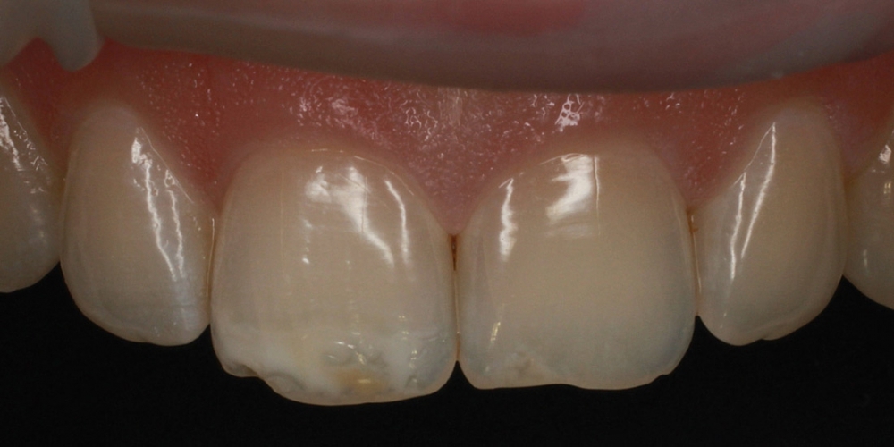 Цельнокерамические виниры E-max на передние зубы - фото №1