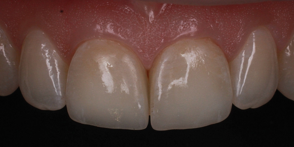 Цельнокерамические виниры E-max на передние зубы - фото №4
