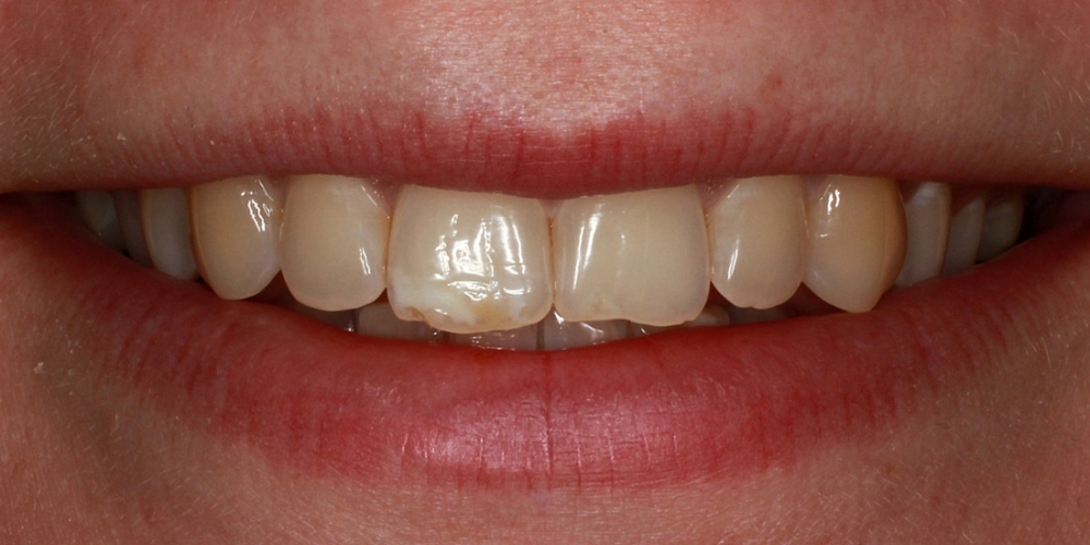 Цельнокерамические виниры E-max на передние зубы - фото №3