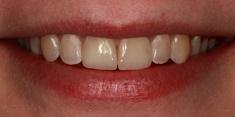 Цельнокерамические виниры E-max на передние зубы - фото №2