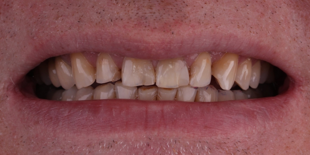 Цельнокерамические виниры на передние зубы без депульпирования зубов - фото №1