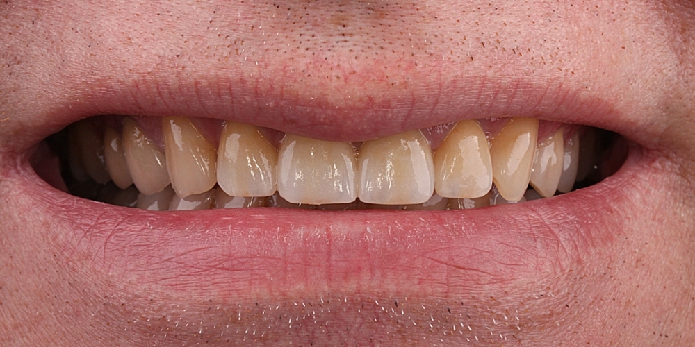 Цельнокерамические виниры на передние зубы без депульпирования зубов - фото №4
