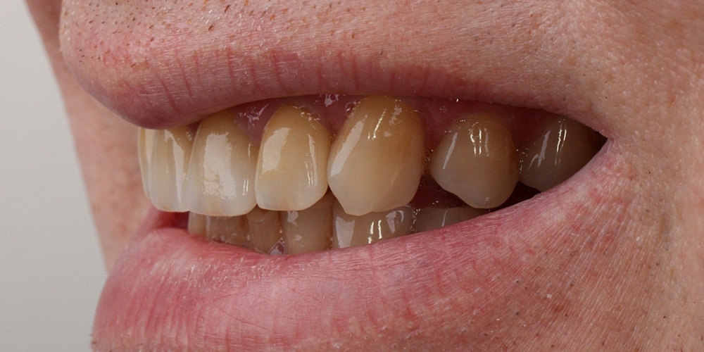 Цельнокерамические виниры на передние зубы без депульпирования зубов - фото №3