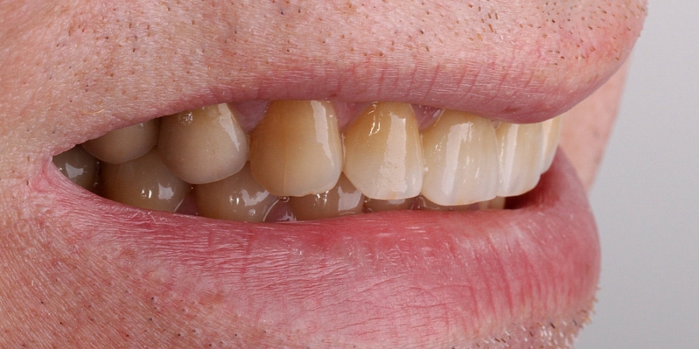Цельнокерамические виниры на передние зубы без депульпирования зубов - фото №2