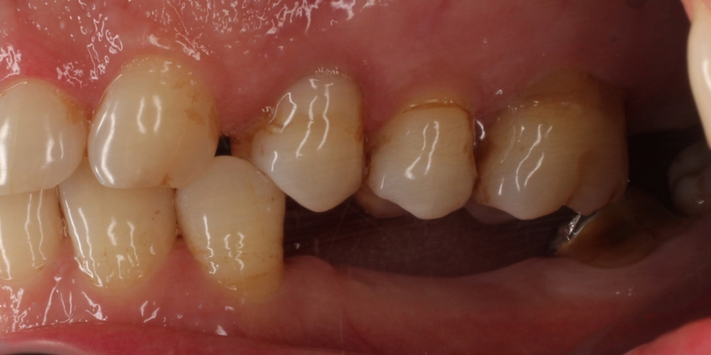 Имплантация трех зубов подряд, м/к коронки - фото №1