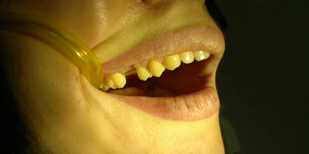 Установка имплантата в область отсутствующего зуба - фото №1