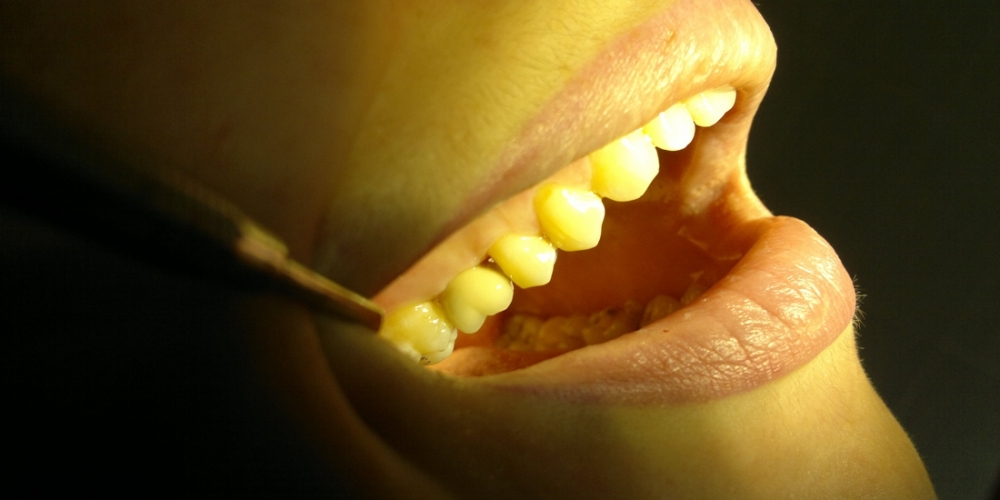 Установка имплантата в область отсутствующего зуба - фото №4