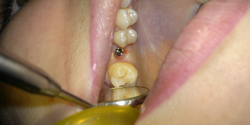 Установка имплантата в область отсутствующего зуба - фото №3