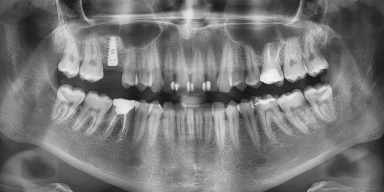 Установка имплантата в область отсутствующего зуба - фото №2
