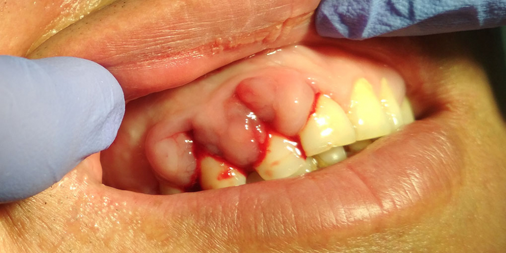 Результат лечения отека десны, кровоточивость при чистке зубов - фото №1