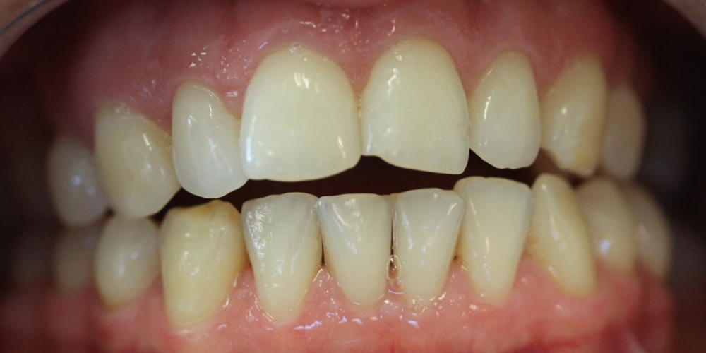 Результат отбеливания зубов системой ZOOM при дисколорите - фото №1
