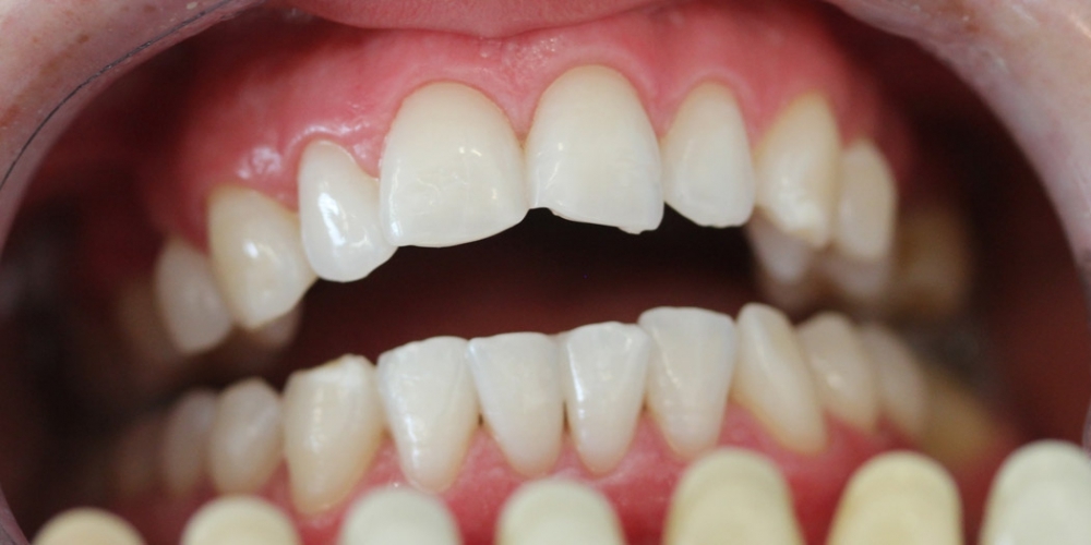 Результат отбеливания зубов системой ZOOM при дисколорите - фото №2