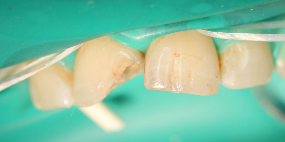 Результат лечение глубокого кариеса двух передних зубов за один прием - фото №1