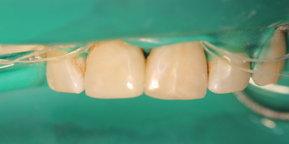 Результат лечение глубокого кариеса двух передних зубов за один прием - фото №2