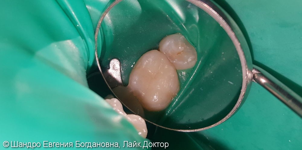 Замена композитной реставрации 26 зуба на новую керамическую вкладку E-max - фото №2